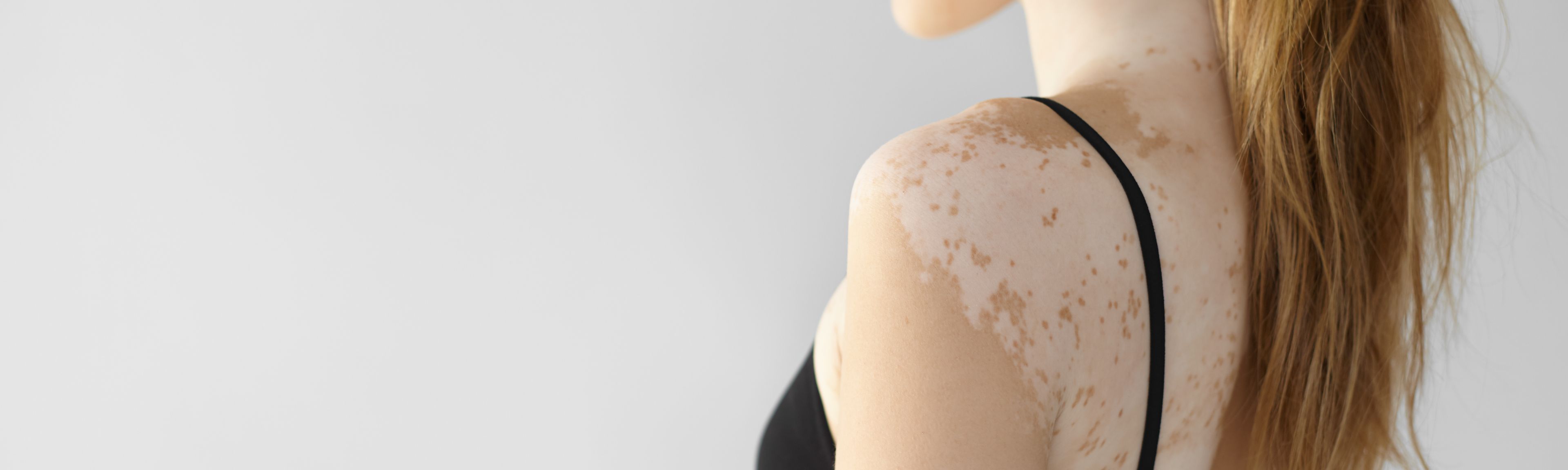 Vitiligo Kur
